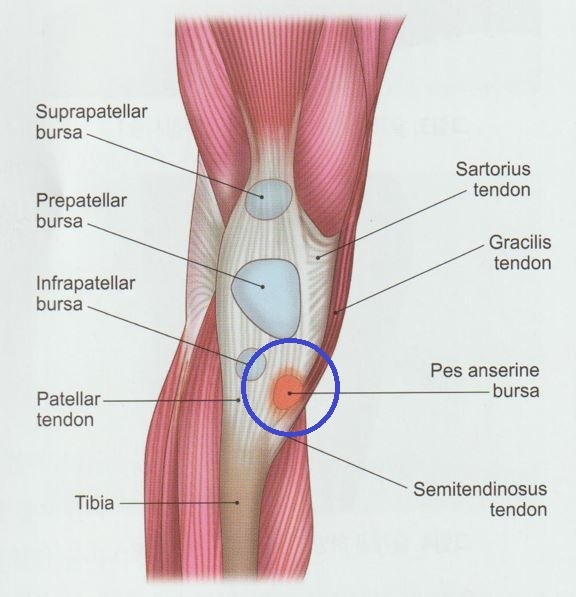 안양 고래한의원 - 거위발 점액낭염 (거위발 활액낭염)