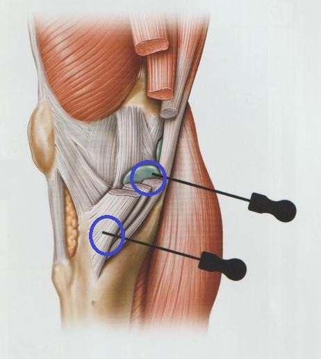 거위발 점액낭염 거위발 활액낭염002