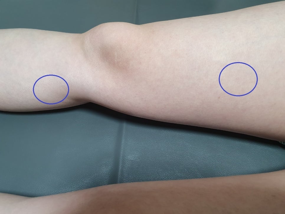 거위발 점액낭염 거위발 활액낭염003