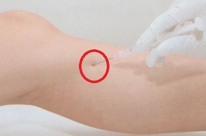 거위발 점액낭염 거위발 활액낭염006