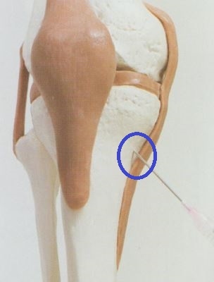 거위발 점액낭염 거위발 활액낭염007