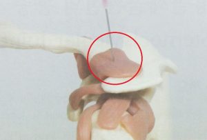 안양 고래한의원 - 견봉쇄골관절염01