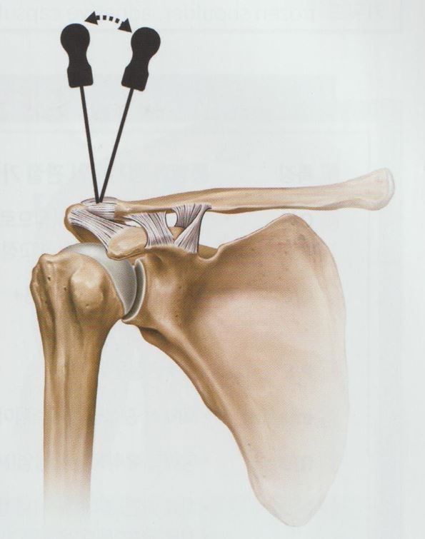 견봉쇄골관절염 3 견봉쇄골관절염02