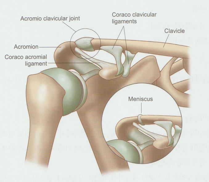 견봉쇄골관절염 5 견봉쇄골관절염04