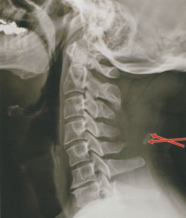 경추 항인대 석회화1