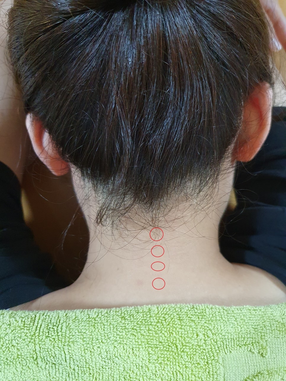 경추 항인대 석회화2