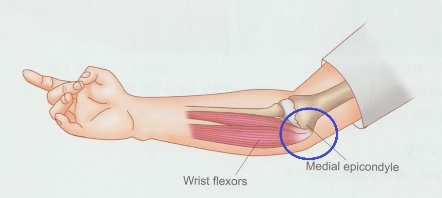 안양 고래한의원 - 골프 엘보우 (주관절 내상과염)