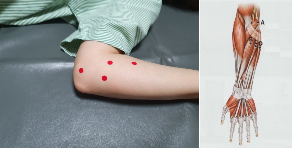 골프 엘보우 주관절 내상과염02