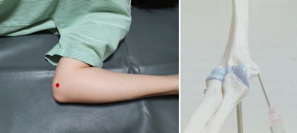 골프 엘보우 주관절 내상과염03