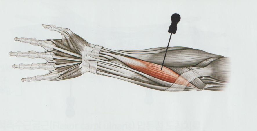 골프 엘보우 주관절 내상과염04