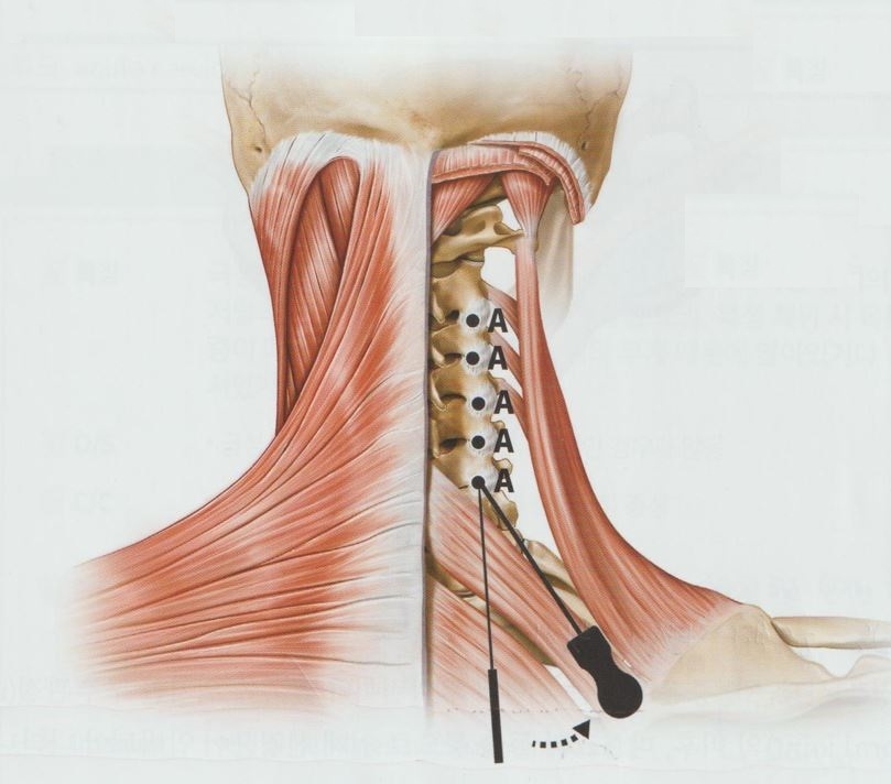 급성 경추 추간판 탈출증 (급성 경추 디스크) 5 급성 경추 추간판 탈출증 급성 경추 디스크04