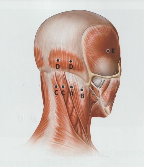 안양 고래한의원 - 긴장성 두통