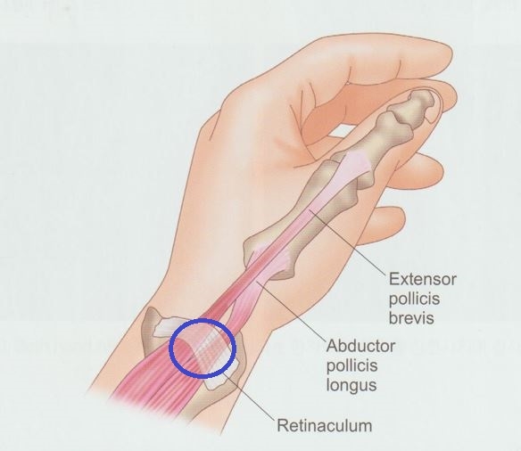 안양 고래한의원 - 드퀘르뱅 병 (협착성 건초염, 드퀘르뱅 건초염)