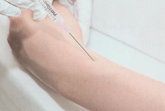 드퀘르뱅 병 협착성 건초염 드퀘르뱅 건초염003