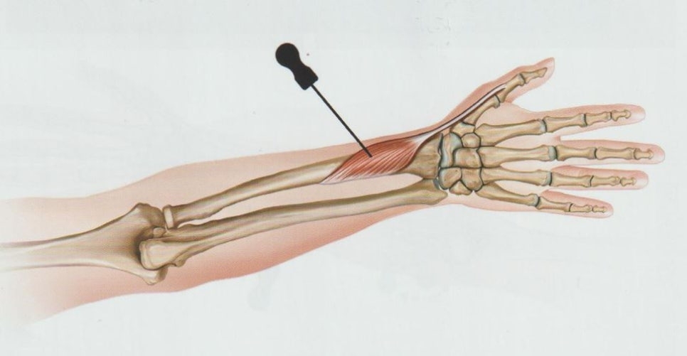 드퀘르뱅 병 협착성 건초염 드퀘르뱅 건초염004