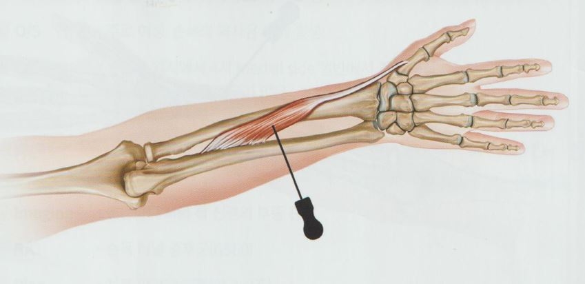드퀘르뱅 병 협착성 건초염 드퀘르뱅 건초염005