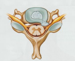 안양 고래한의원 - 만성 경추 신경근 병증 만성 경추 디스크1