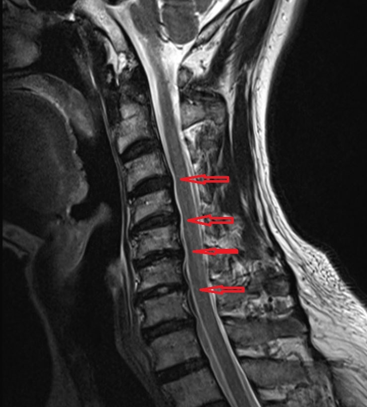 만성 경추 신경근 병증 (만성 경추 디스크) 4 만성 경추 신경근 병증 만성 경추 디스크3