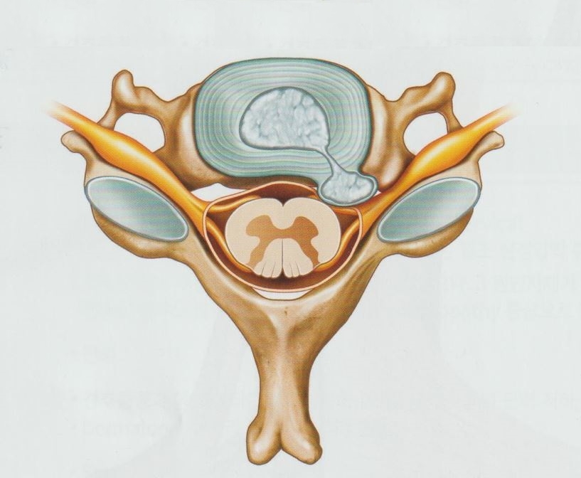 만성 경추 신경근 병증 (만성 경추 디스크) 6 만성 경추 신경근 병증 만성 경추 디스크5