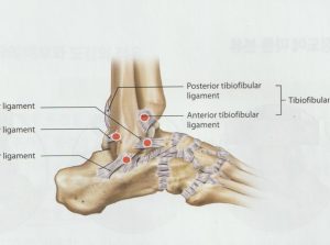 안양 고래한의원 - 발목관절 염좌001