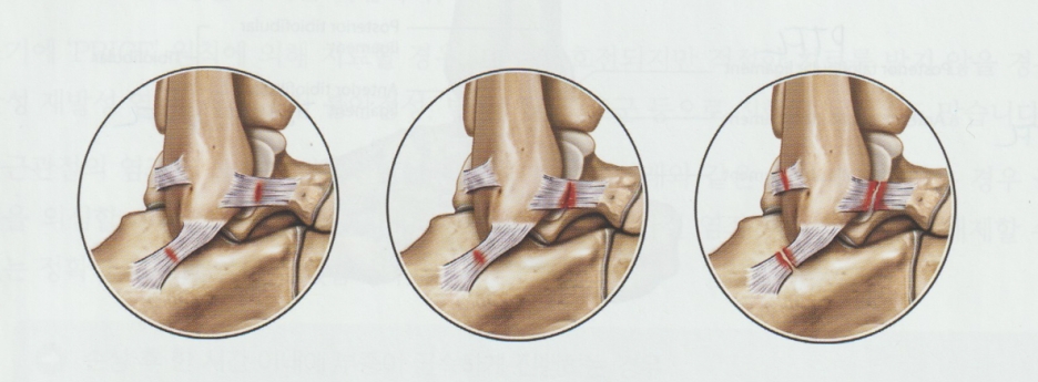 발목관절 염좌002