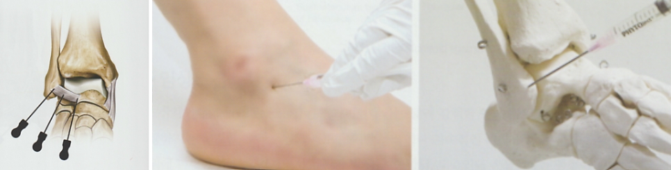 발목관절 염좌003