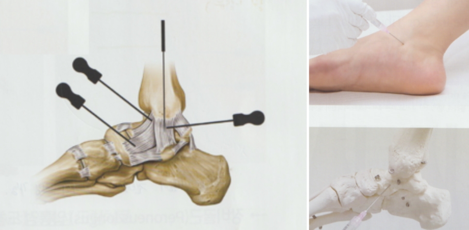 발목관절 염좌004