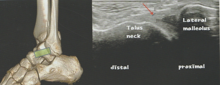 발목관절 염좌005