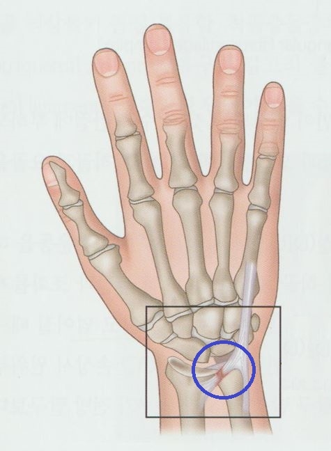 안양 고래한의원 - 삼각섬유연골복합체 손상 (TFCC)