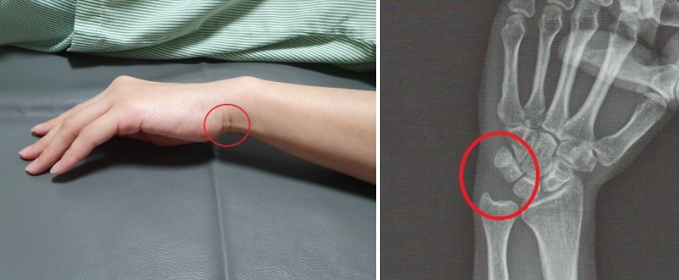 삼각섬유연골복합체 손상 TFCC002