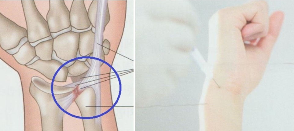 삼각섬유연골복합체 손상 TFCC003