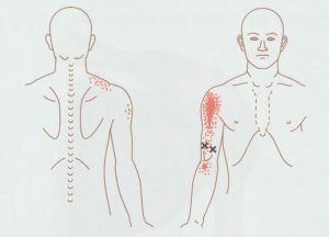 안양 고래한의원 - 상완이두근건염01 1