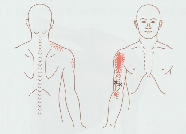 안양 고래한의원 - 상완이두근건염