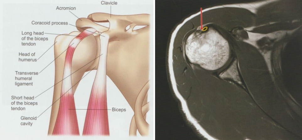 상완이두근건염02 1