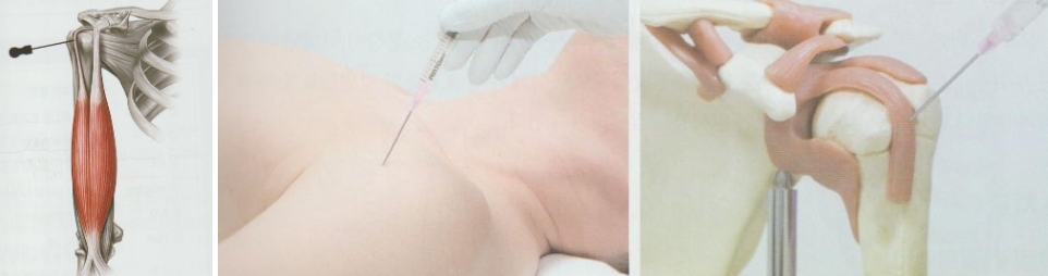 상완이두근건염03 1