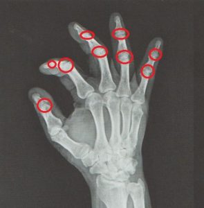 안양 고래한의원 - 손가락 퇴행성 관절염001