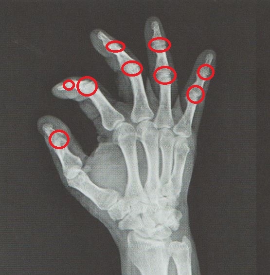 안양 고래한의원 - 손가락 퇴행성 관절염