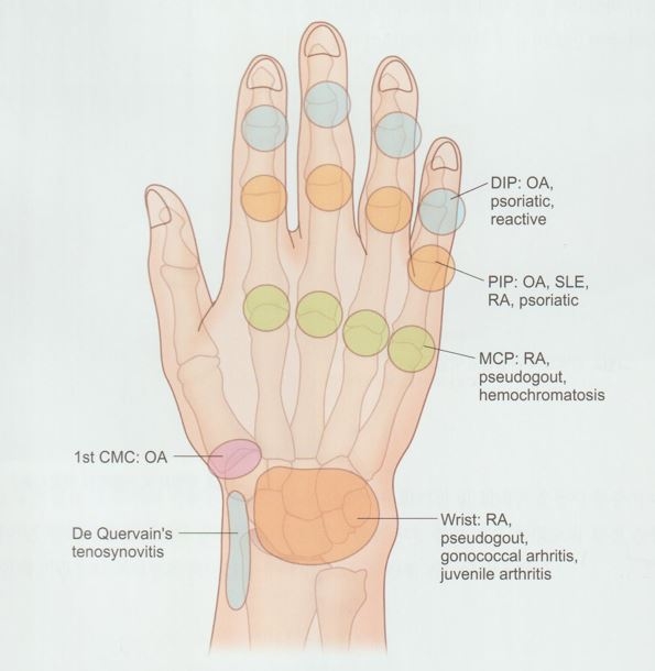 손가락 퇴행성 관절염002