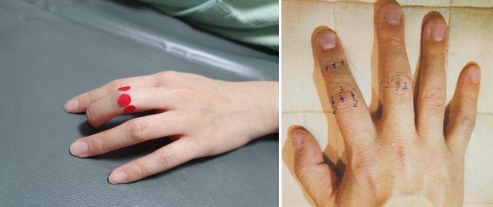 손가락 퇴행성 관절염003