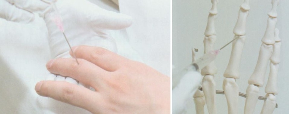 손가락 퇴행성 관절염004