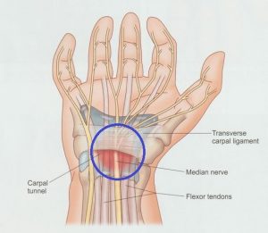 안양 고래한의원 - 손목터널 증후군 수근관 증후군001