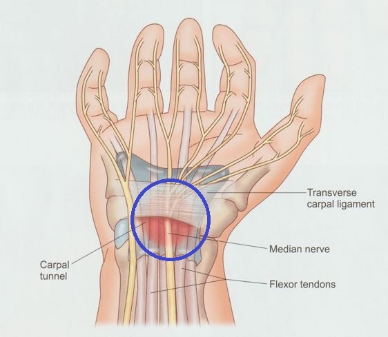 안양 고래한의원 - 손목터널 증후군 (수근관 증후군)