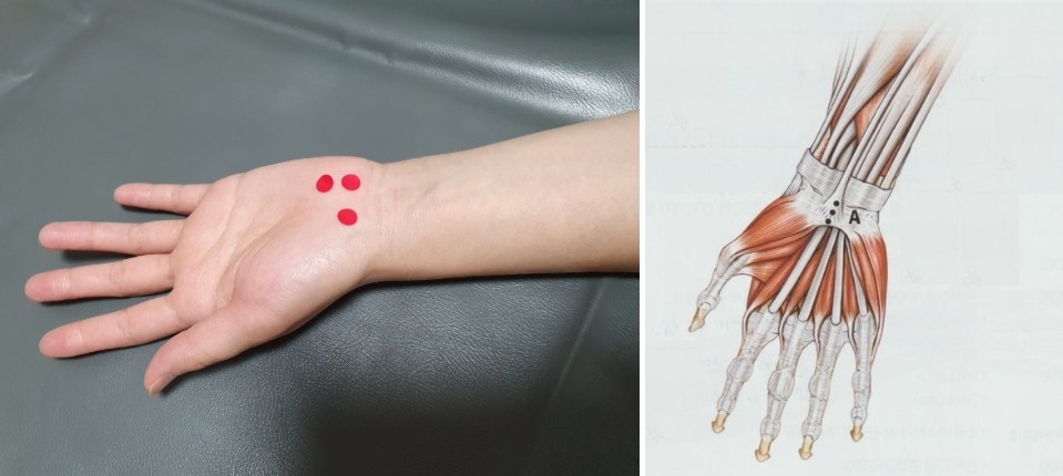 손목터널 증후군 수근관 증후군002