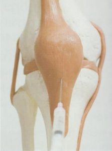 안양 고래한의원 - 슬개건염001