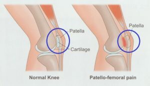 안양 고래한의원 - 슬개대퇴통증 증후군001