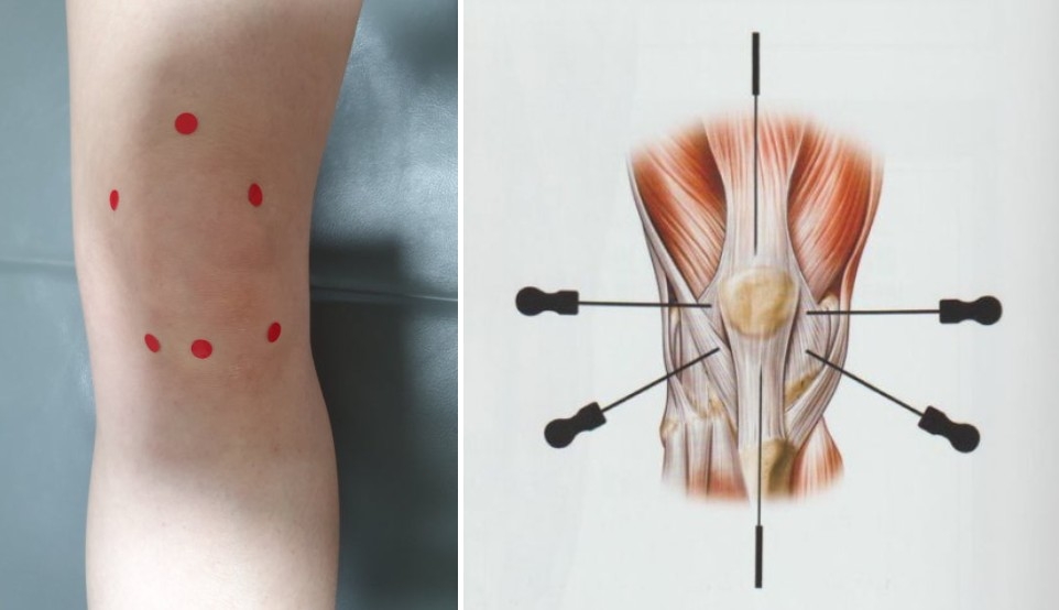 슬개대퇴통증 증후군002