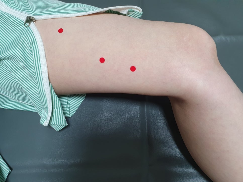 슬개대퇴통증 증후군005