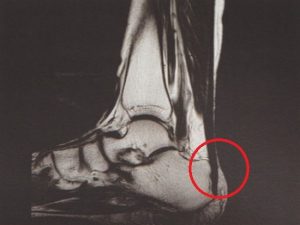 안양 고래한의원 - 아킬레스 건염001