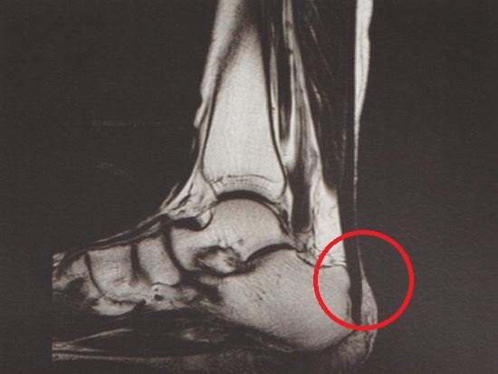 아킬레스 건염 2 아킬레스 건염001