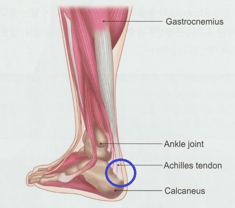 아킬레스 건염 3 아킬레스 건염002